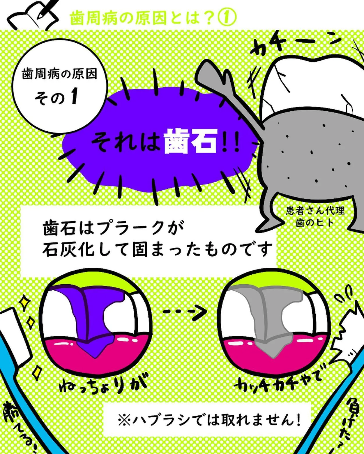 歯周病の原因とは？1️⃣🦷