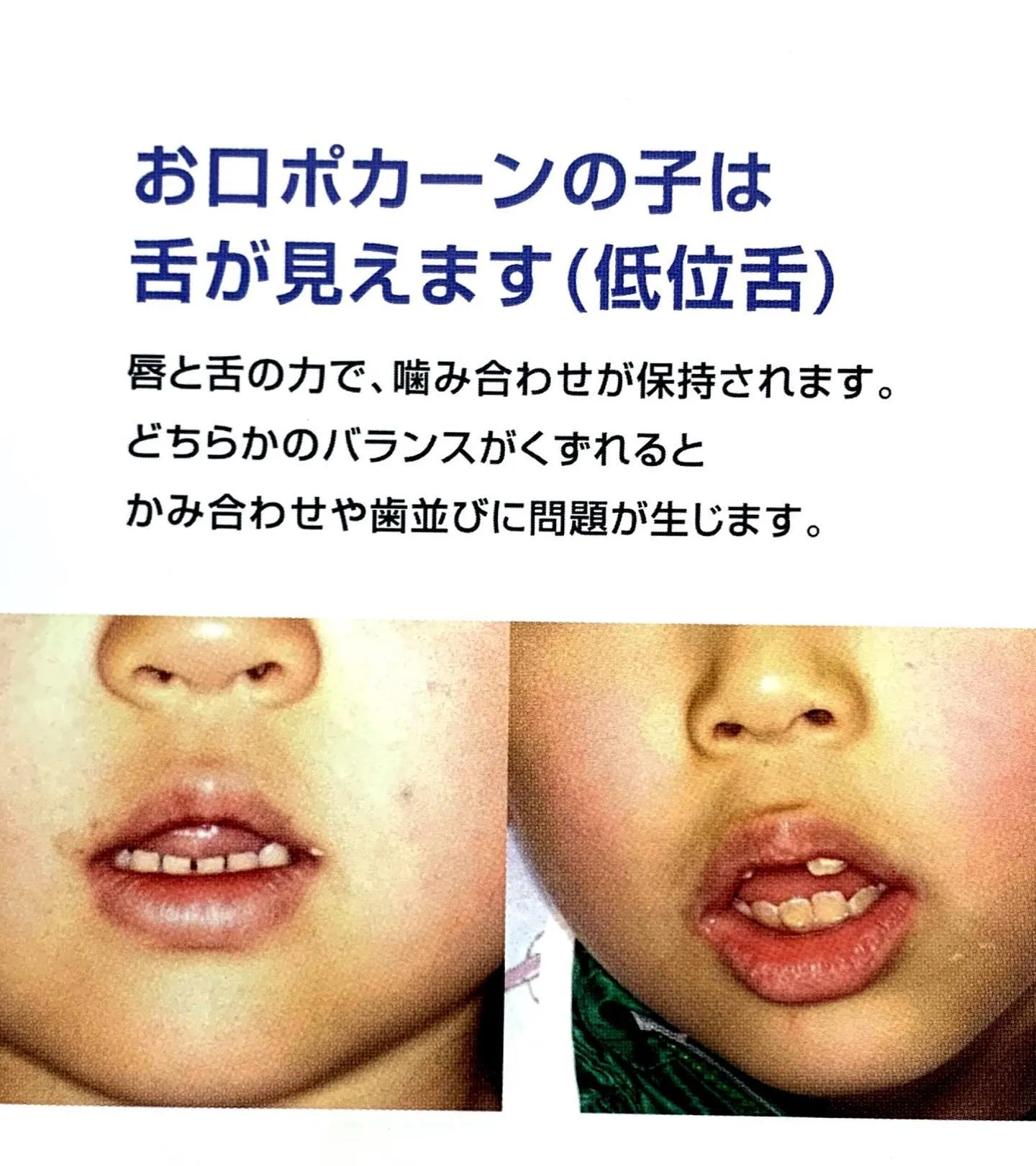 お子さんの歯並びについて①