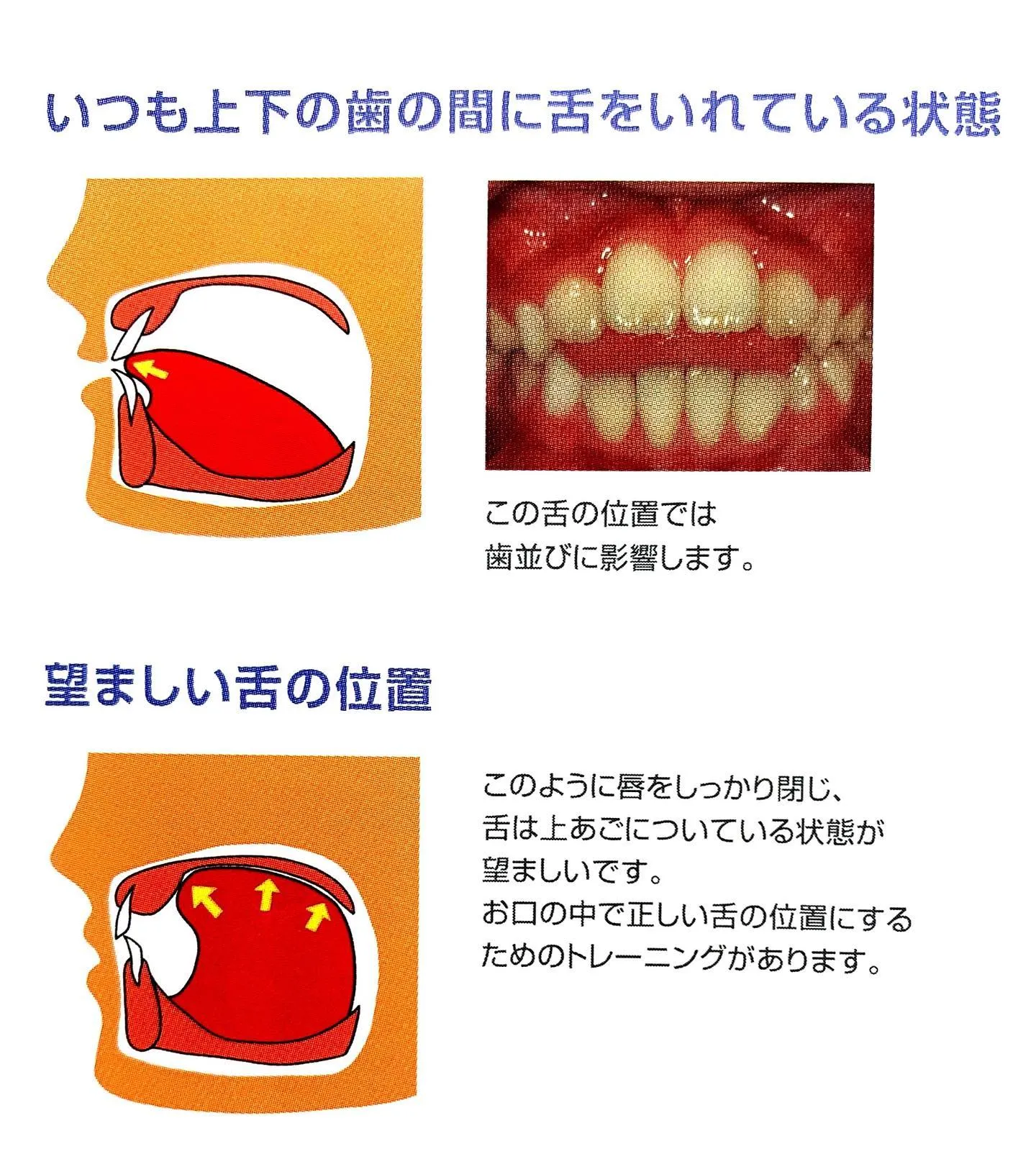 お子さんの歯並びについて①