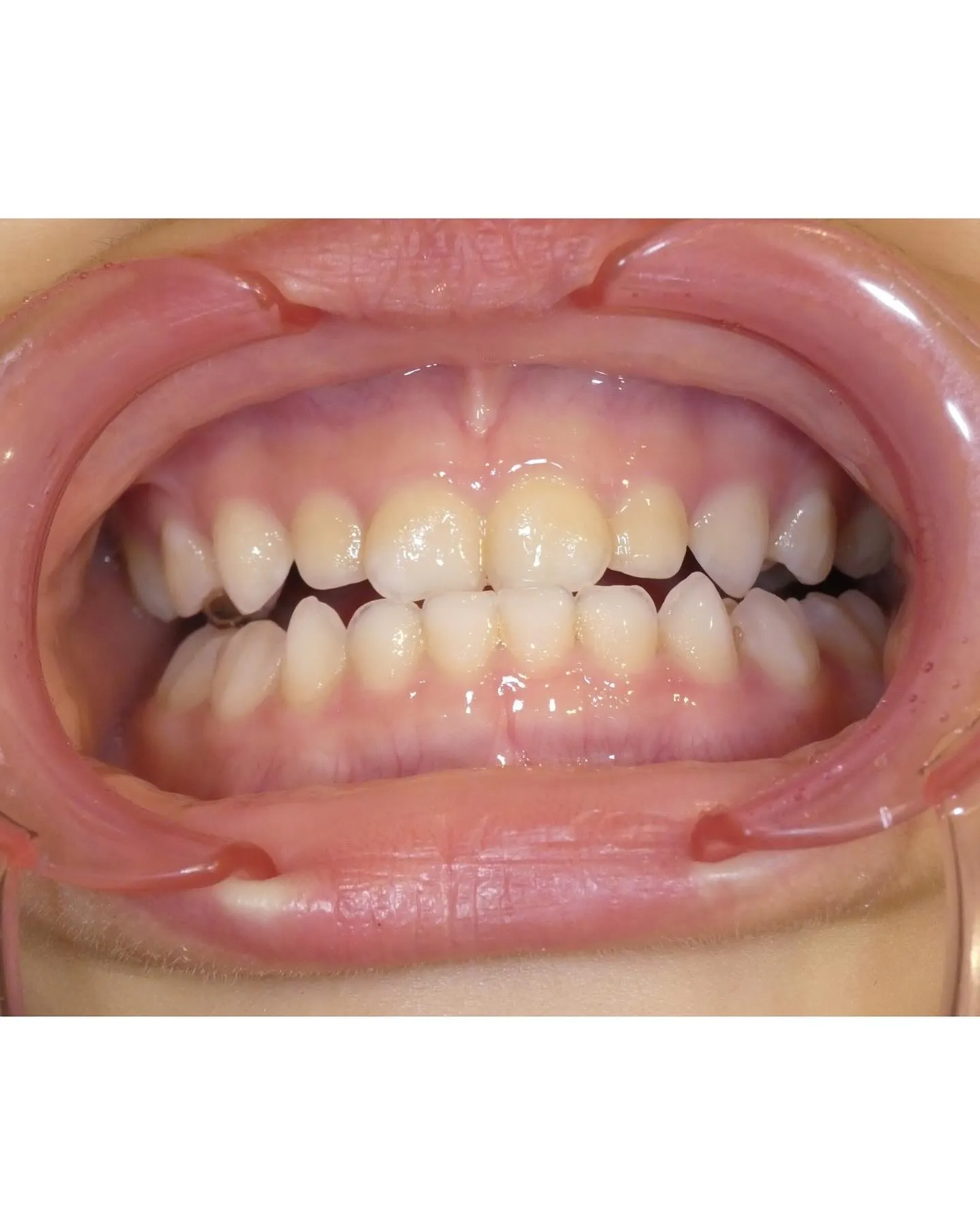 お子さんの歯🦷のクリーニング