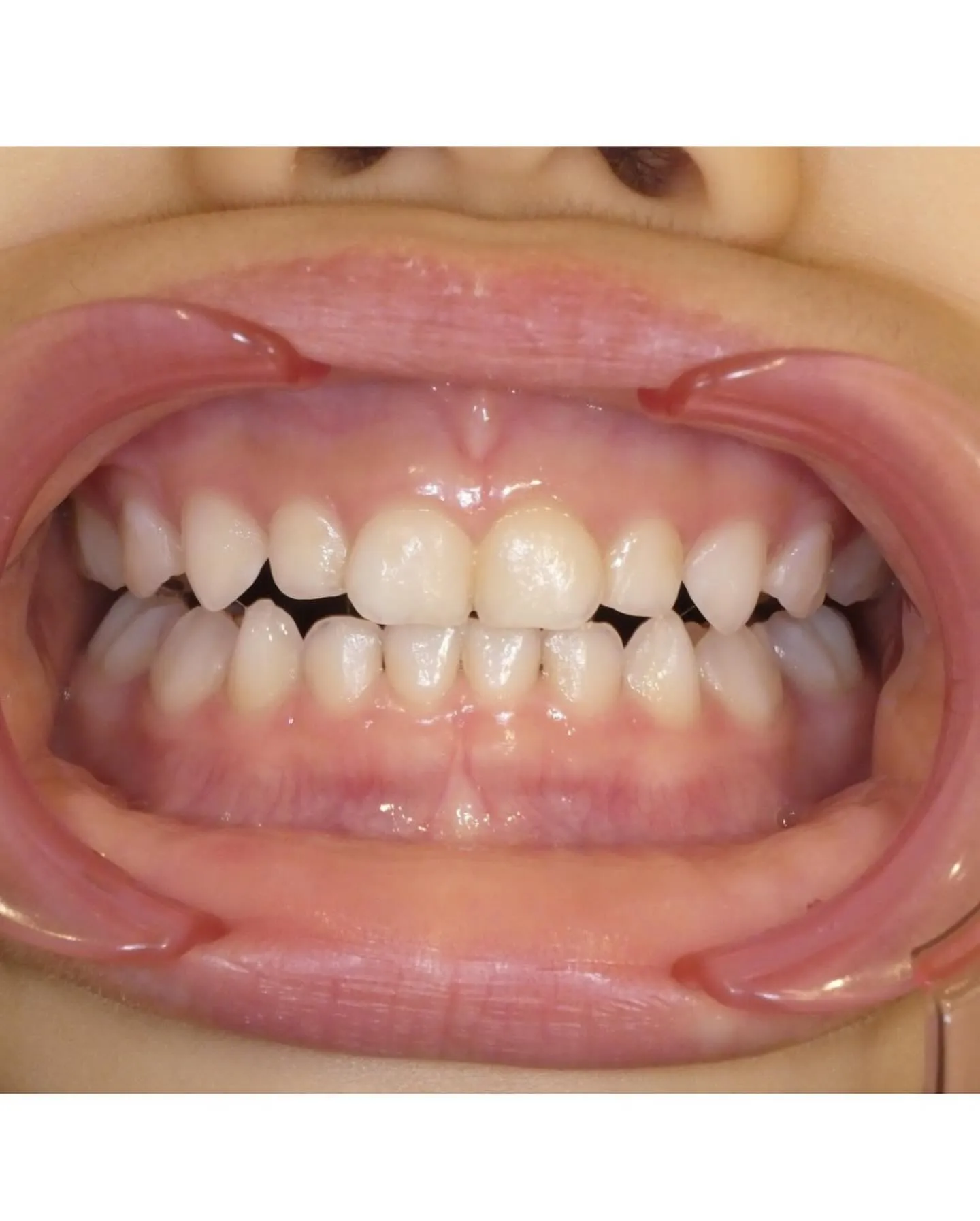 お子さんの歯🦷のクリーニング