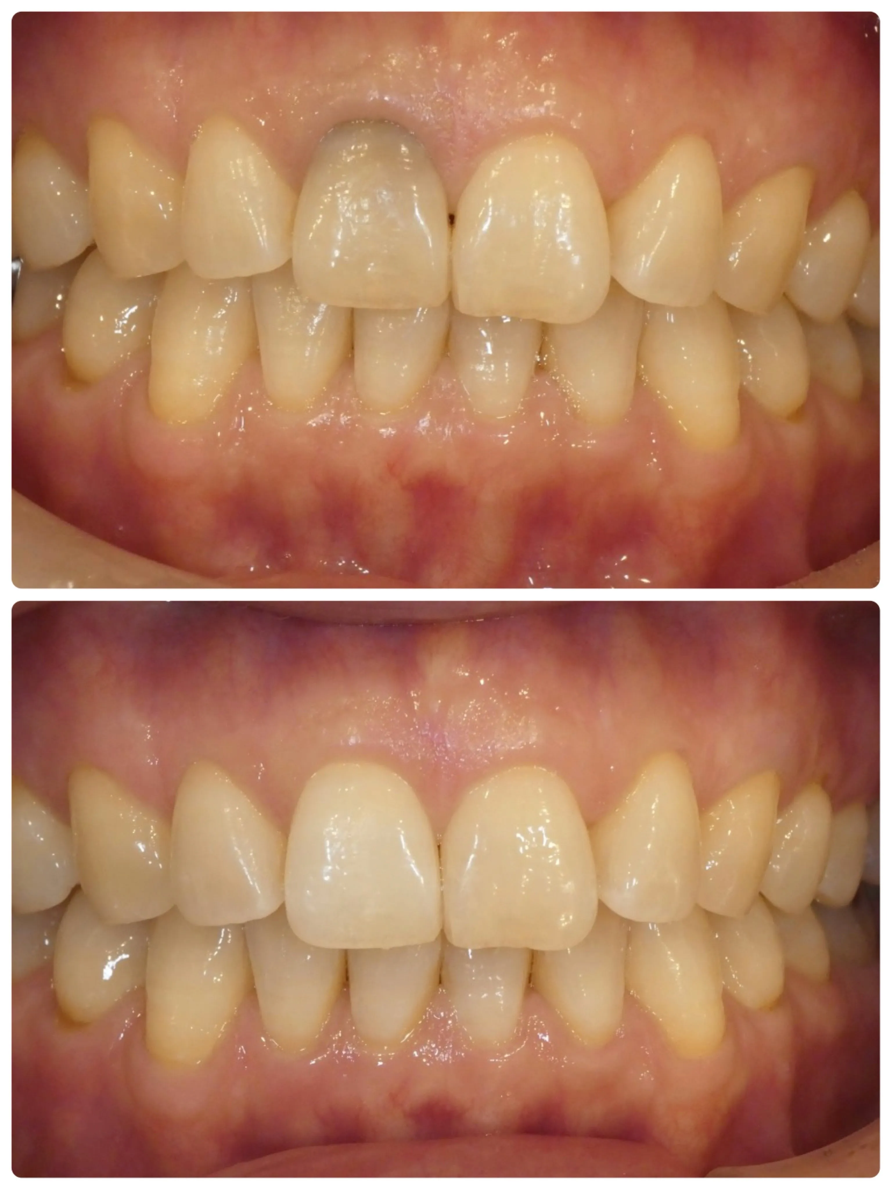 🦷 前歯のウォーキングブリーチ症例🦷