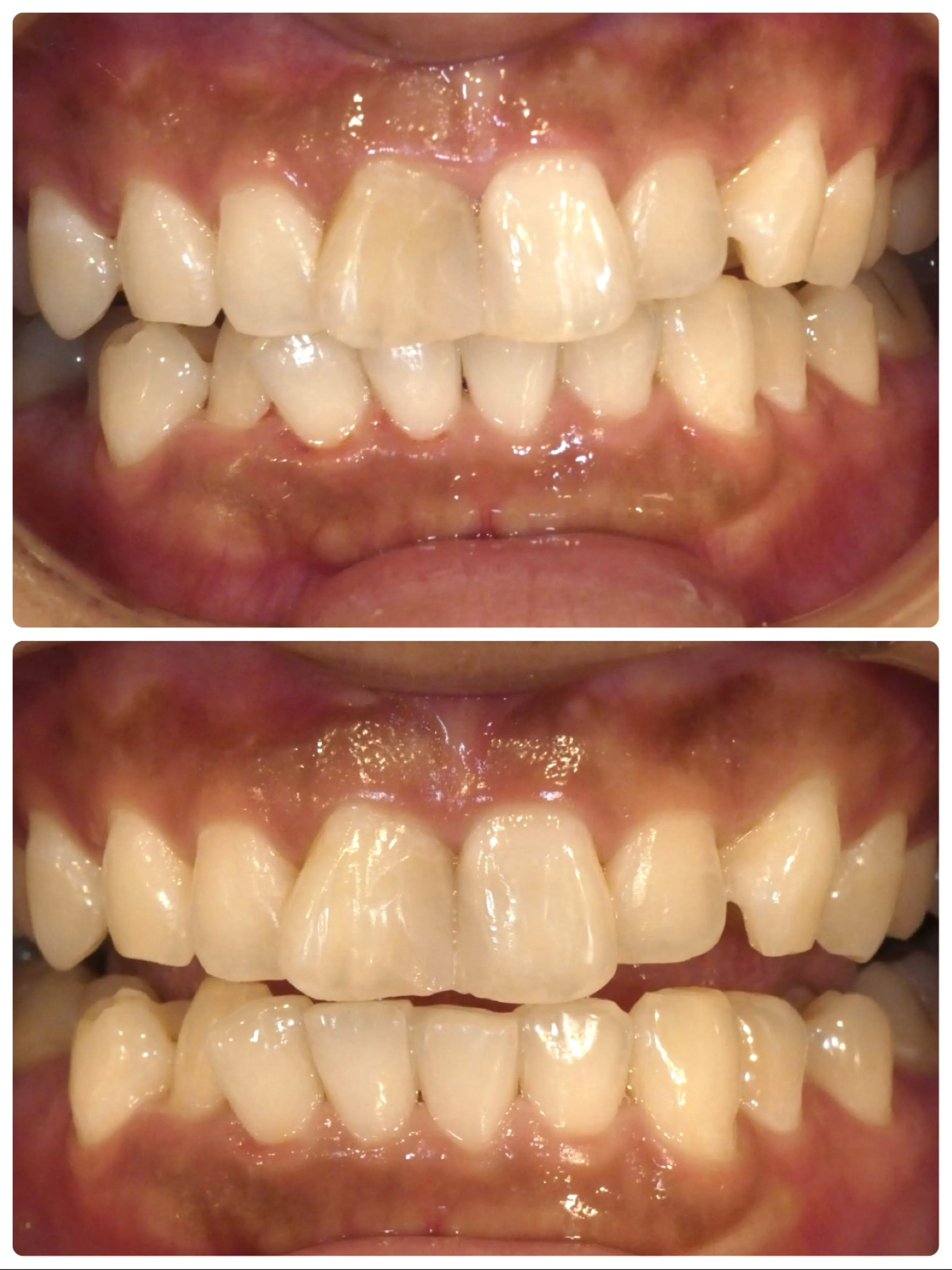 🦷 前歯のウォーキングブリーチ症例🦷